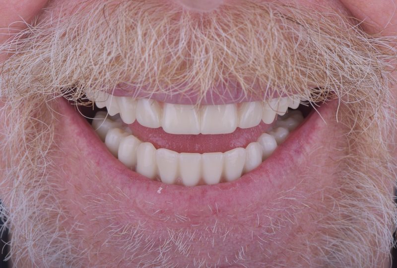 After: fully restored smile with natural-looking teeth