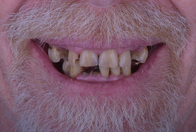 Before: severely damaged and discolored teeth