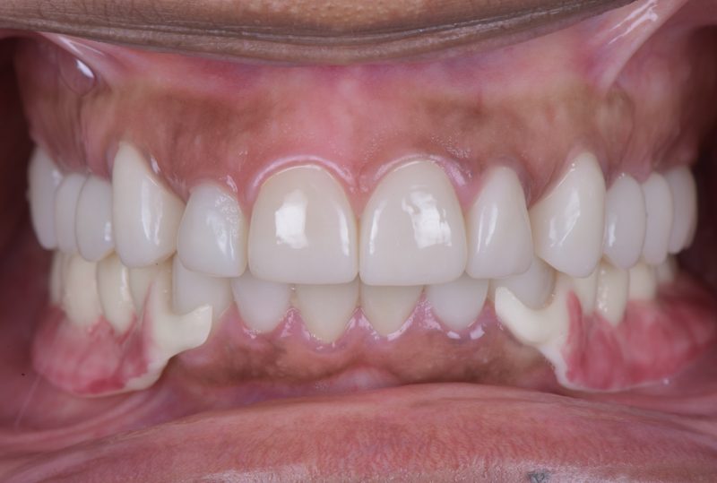 After: aligned, natural-looking smile