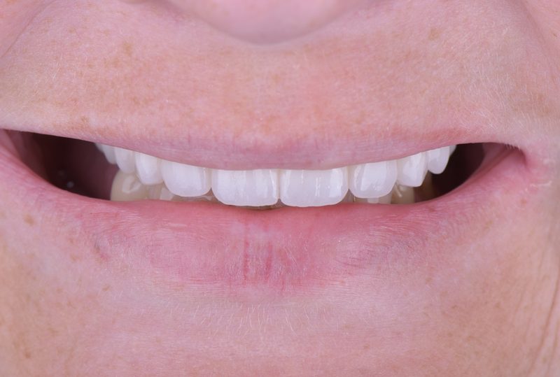 After: bright, even smile