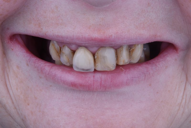 Before: discolored and damaged front teeth