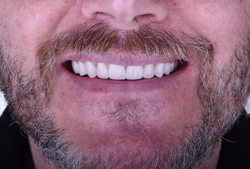 After: complete smile restoration