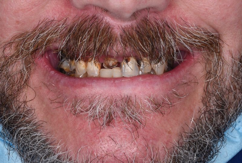 Before: worn, stained teeth with decay