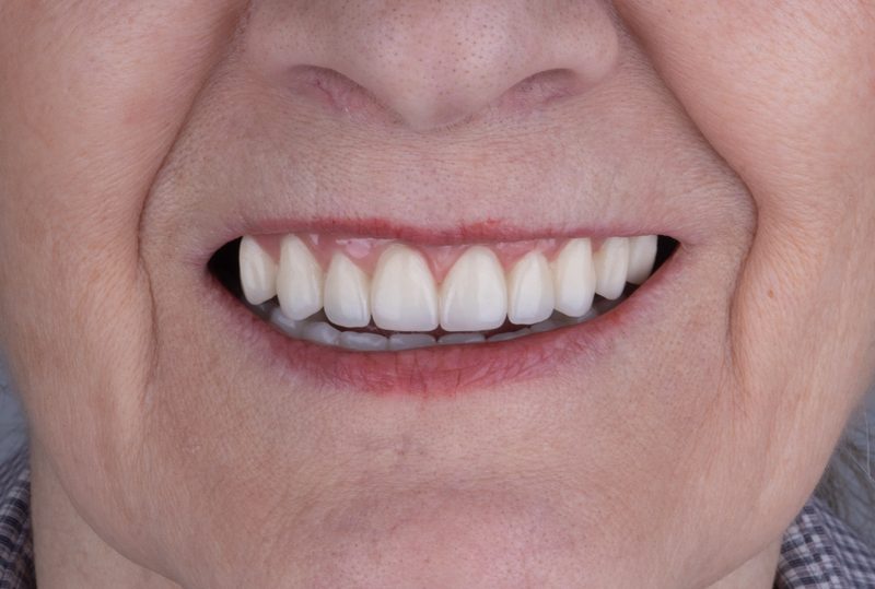 After: beautiful full set of teeth