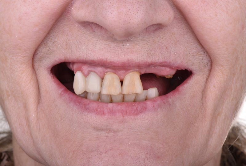 Before: multiple missing teeth