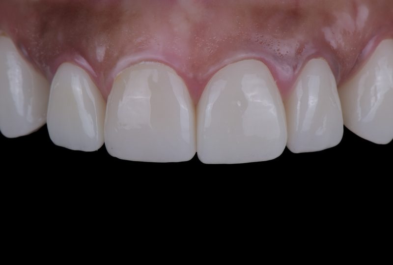 After: flawless porcelain veneers