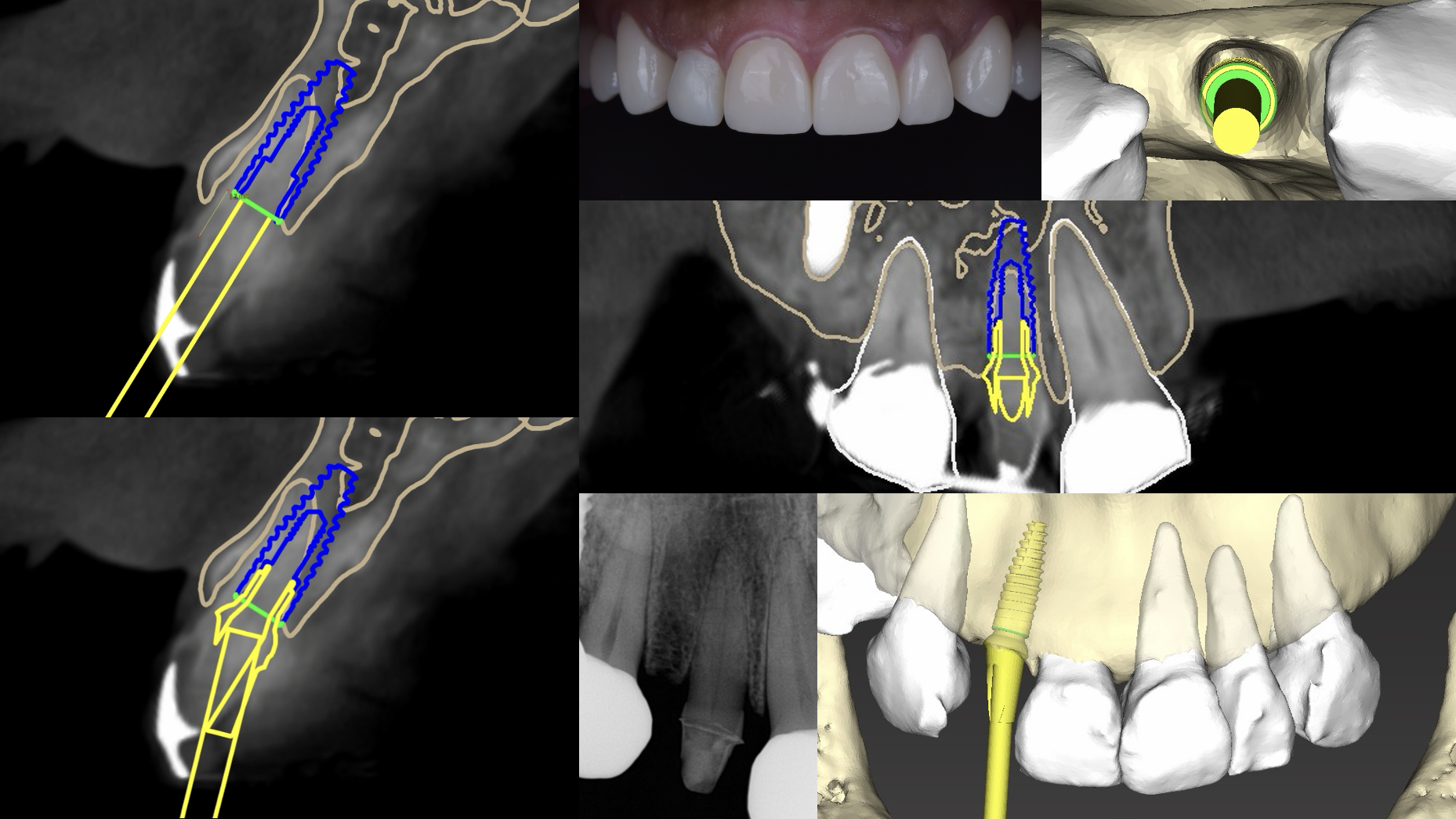 CT simulation and 3D implant planning at Eden Dental Office Nagoya