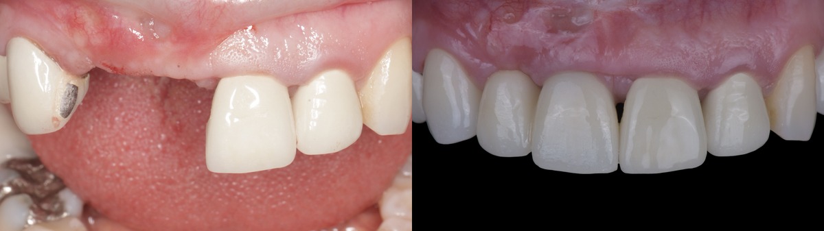 Aesthetic dentistry before and after — natural smile restoration