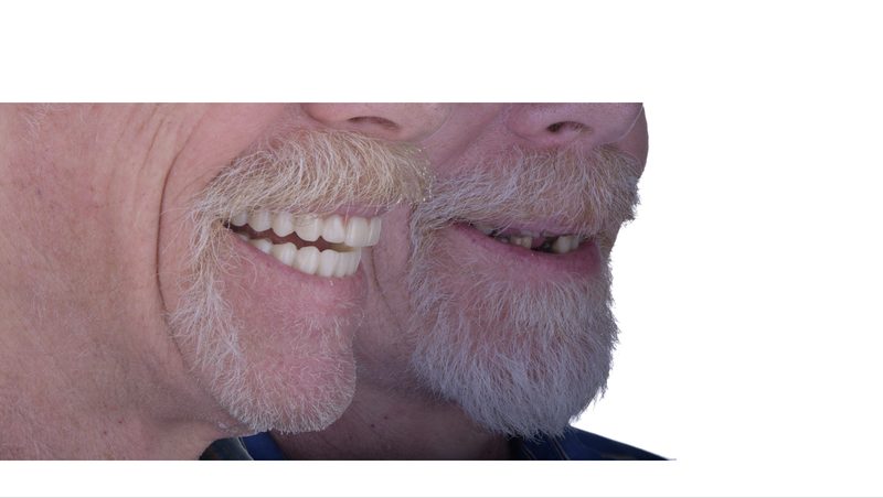 Full-arch restoration before and after — confident smile restored